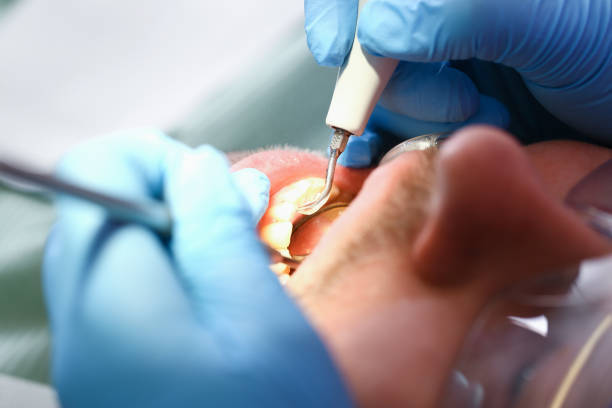 Best Emergency Tooth Extraction in Manche Village, CA